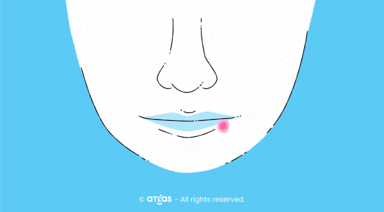 Herpes Simplex | Implicații, complicații, soluții